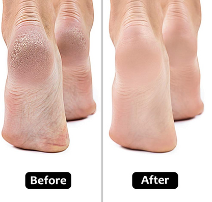 Omi™ Electric Foot Callus Remover